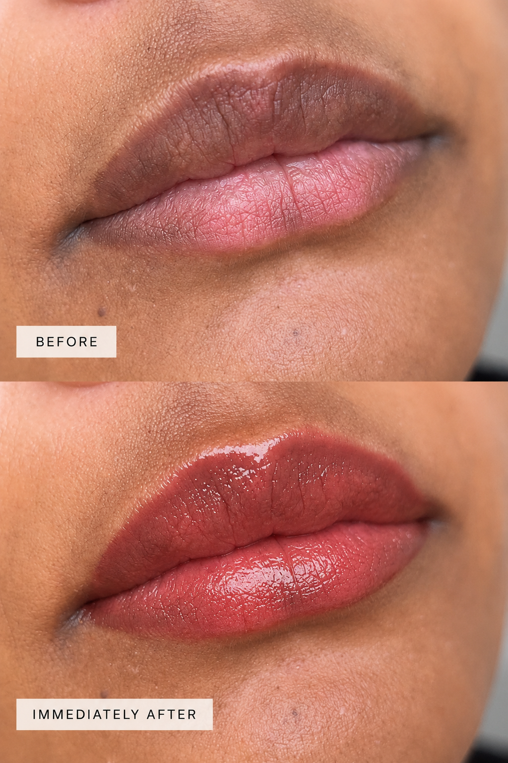 Lip neutralisation before and after result